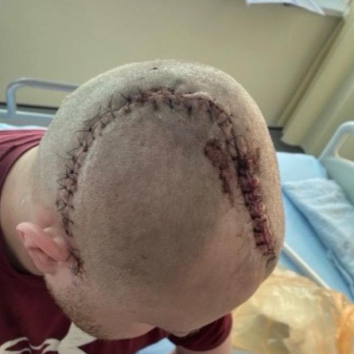 Adam Harcombe needed stitches after surgery to his head