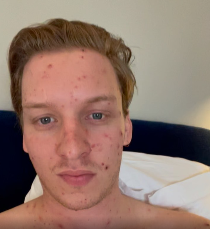 George Ezra with chickenpox