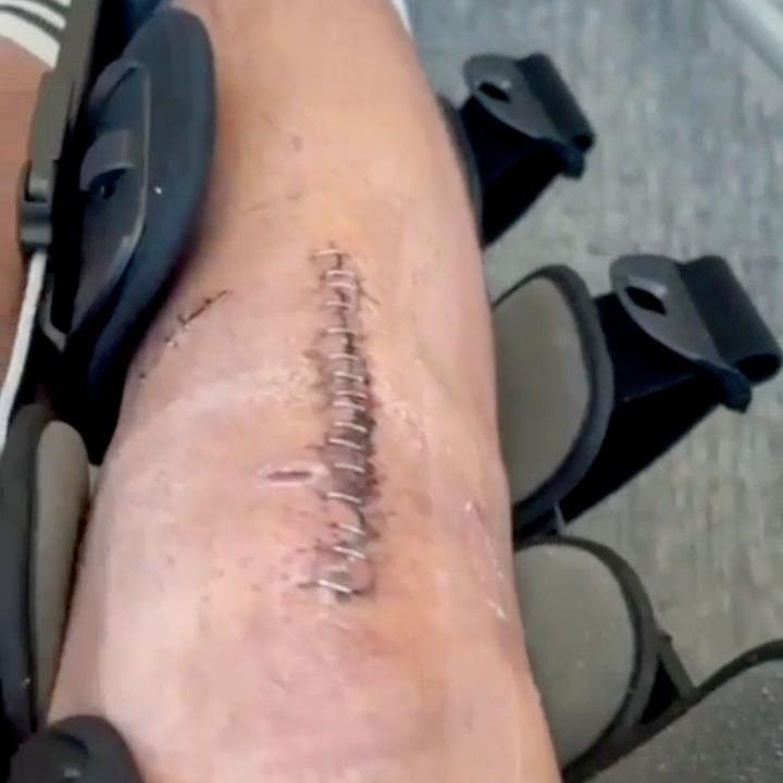 Macauley Southam-Hales shows the staples on his leg after surgery on his patella tendon