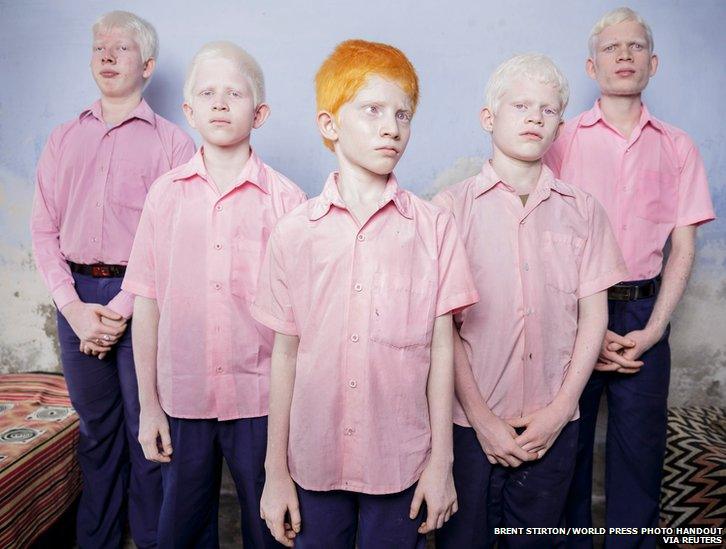 Blind albino boys in their boarding room at the Vivekananda mission school for the blind in West Bengal