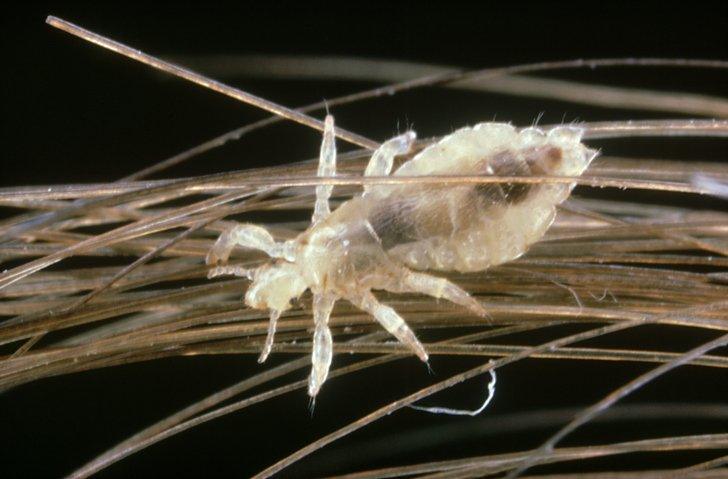 head lice