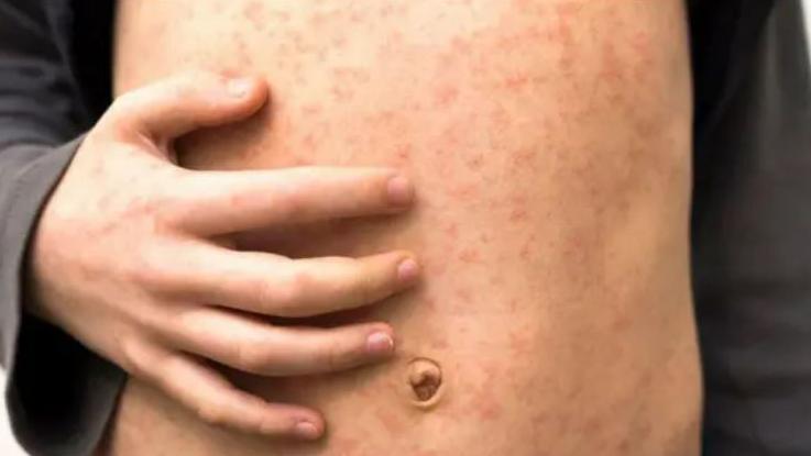 A close-up of a child's stomach with a rash