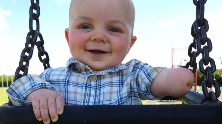 Arthur, 10 months old, who was born without a lower left arm, sits in a playground swing