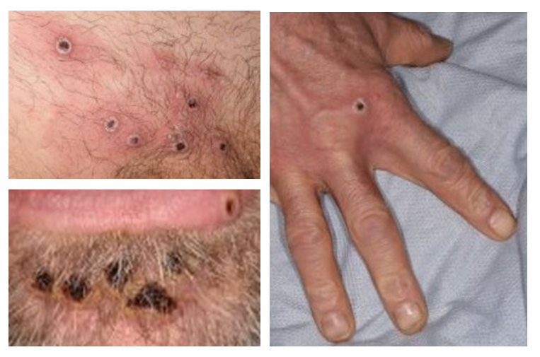 Examples of monkeypox rashes