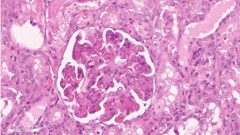 The image is pink is colour. It shows a number of cell like structures under a microscope. The different structures are Cutaneous and Renal Glomerular Vasculopathy, also known as Alabama rot.