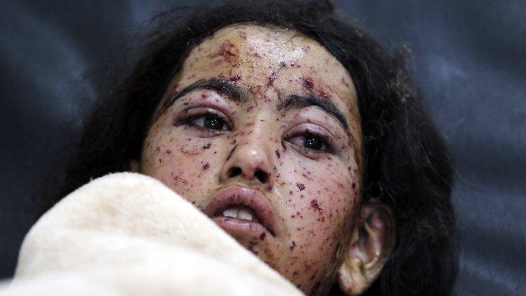 A Yemeni child lies on a bed at a hospital after she was injured in an alleged Saudi-led airstrike