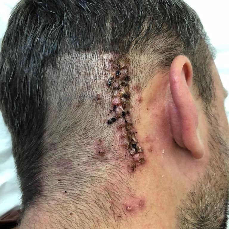 Llun o gefn pen Gerwyn. Mae craith gyda pwythau yn rhedeg tu ol i'w glust. 