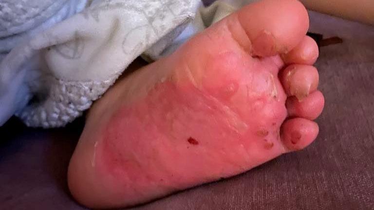 A close up picture of the sole of Edison's foot. It is red and the skin is peeling in places.