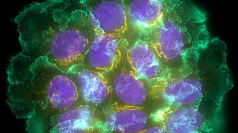 Breast cancer cells