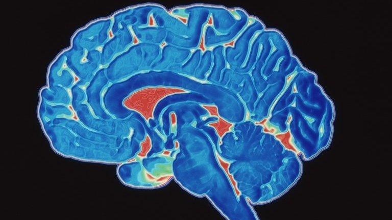 A coloured CT scan image of a human brain