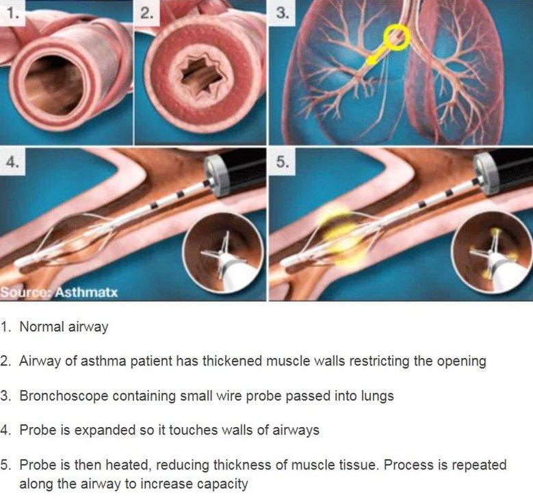 Diagram of bronchial thermoplasty