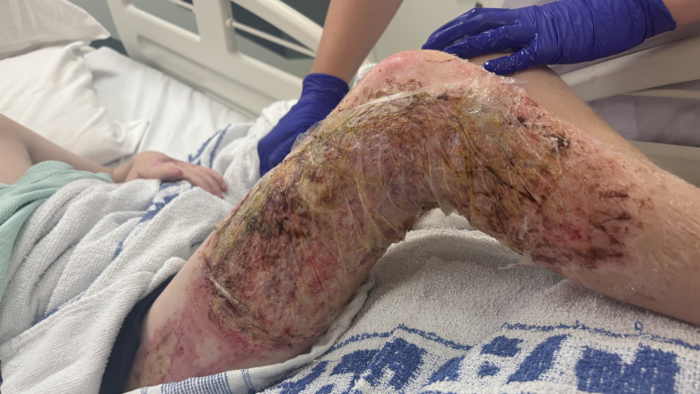 A boys badly burned leg with hospital dressings on it