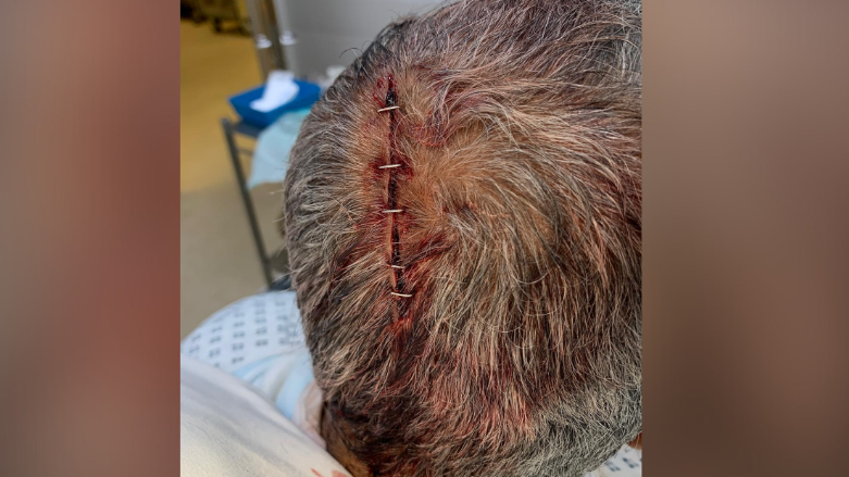 Close up of the back of the victim's head which is covered in short grey hair. In the middle their is a gash held together with staples