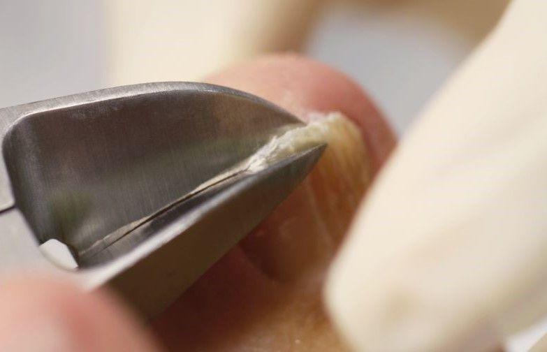 Toenail being clipped