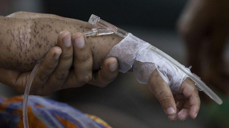 Hundreds of children die within months as measles cases soar in Bangladesh