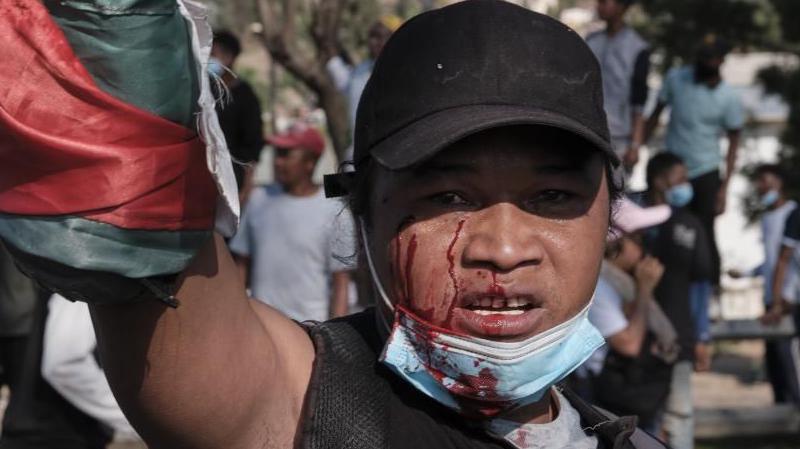 An injured man bleeds during an anti-government protest in Antananarivo, Madagascar, 11 October 2025