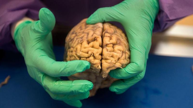 Brain disease in dead NFL players 'higher than previously shown'