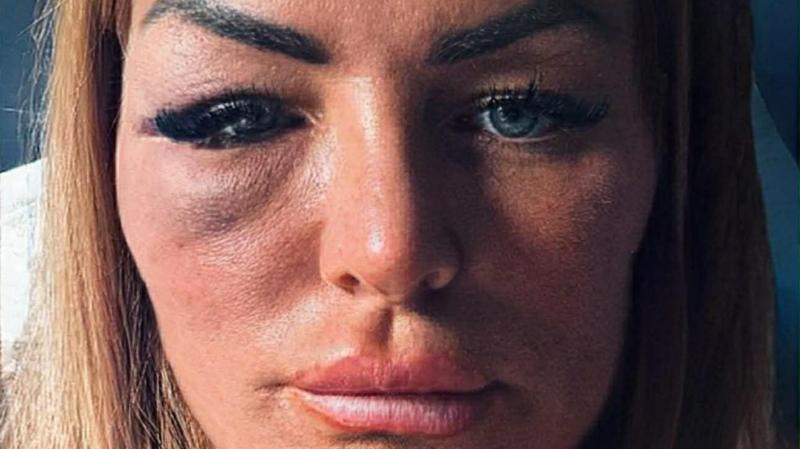 I turned down MMA fighter on a night out - so he punched me