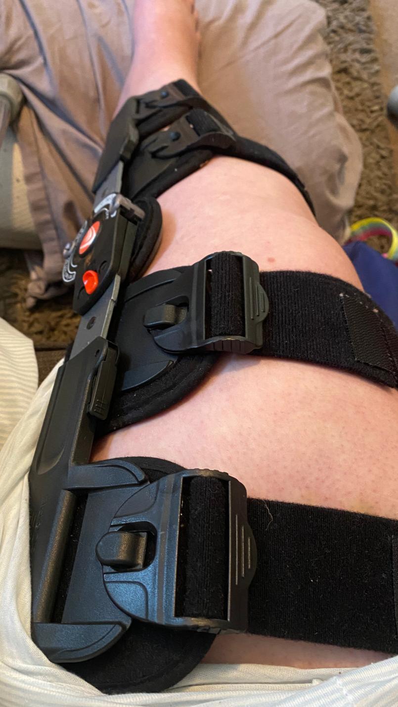 Abbie-Louise Kirby's leg brace after an e-scooter accident