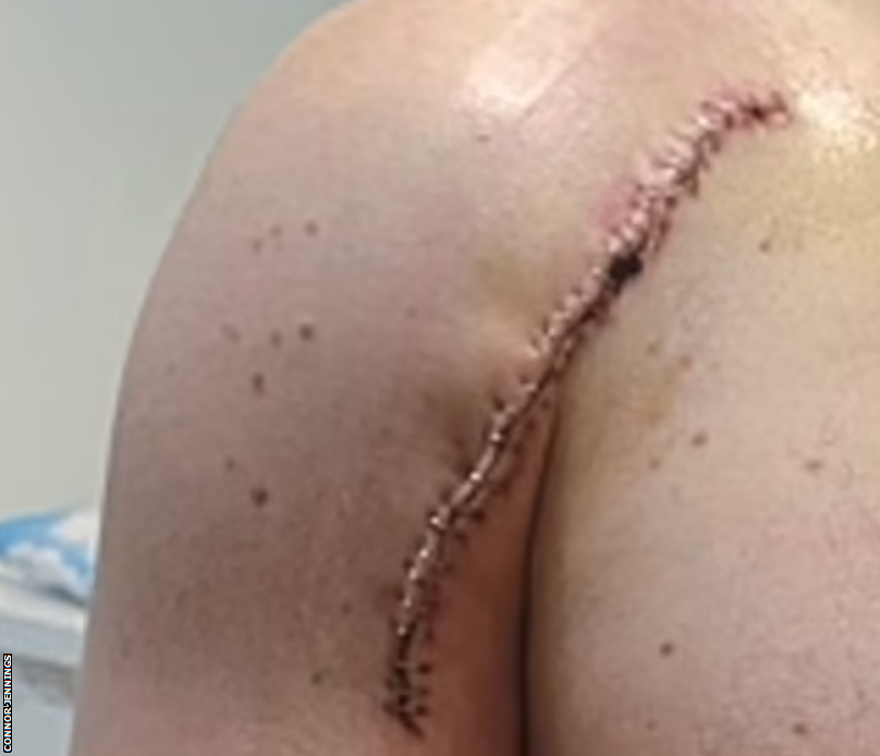 Connor Jennings' shoulder where the tumour was cut out