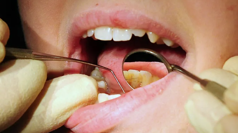 A close up of a dental patient's mouth as they undergo an examination