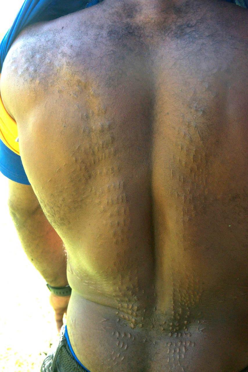 Man in Womburn with back scarred to resemble a crocodile's hide