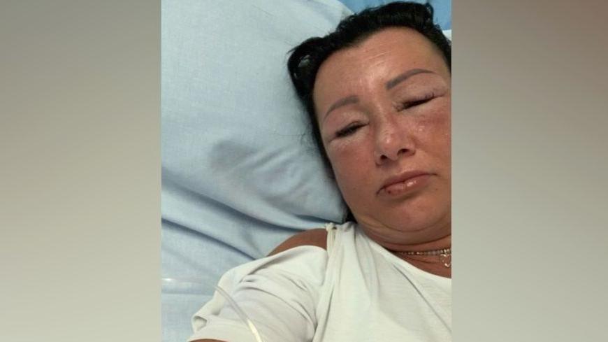 Edith lying in a hospital bed, her left arm hooked up to an IV drip. She is wearing a white t-shirt and her face and eyes are swollen.
