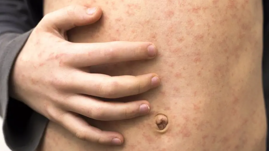 A close-up of a child's tummy with a hand placed on the stomach, both covered in a red rash