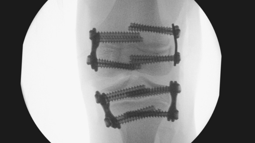 A black and white x-ray image that shows quad plates fixed above and below Amy's knee joint. The screws are long and overlap in the centre of the picture and the plates are fixed to the outside of the femur and the tibia