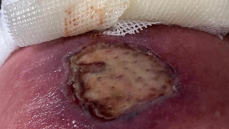 Picture of the third degree burn beneath a bandage which has become infected with pus. 