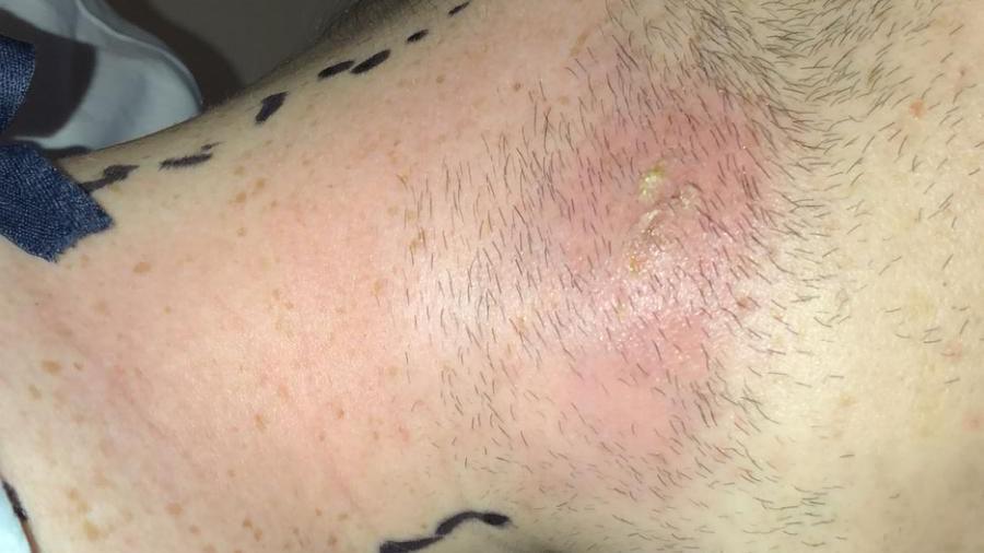 A picture of the large abscess on his neck, which looks like a large red rash.