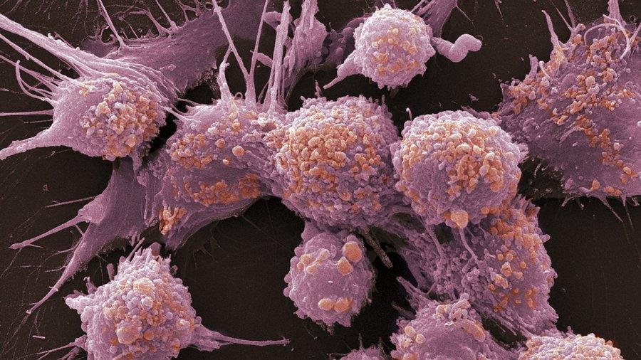 Prostate cancer cells