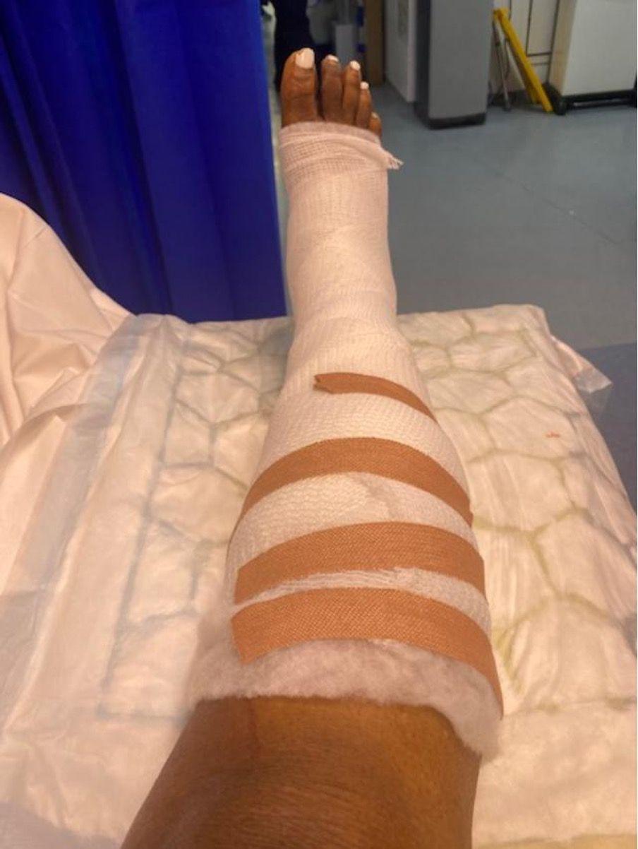 Lucy Daramola's leg bandaged up in a hospital setting