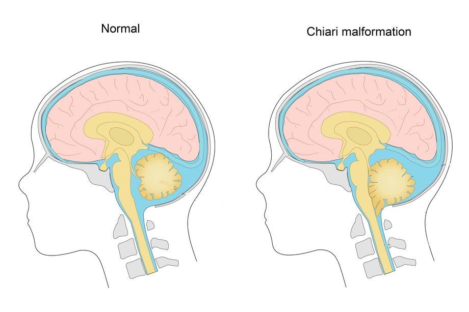 Diagram showing a Chiari Malformation