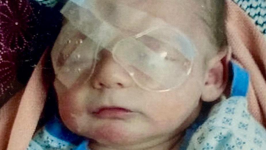 Ben as a baby, with plastic eye coverings over both of his eyes, with tape across them.