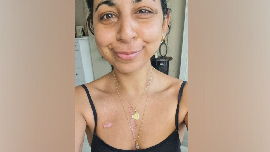 Sanj smiles at the camera, wearing a black vest and gold necklace. Pink scarring is visible on her chest from the transplant 