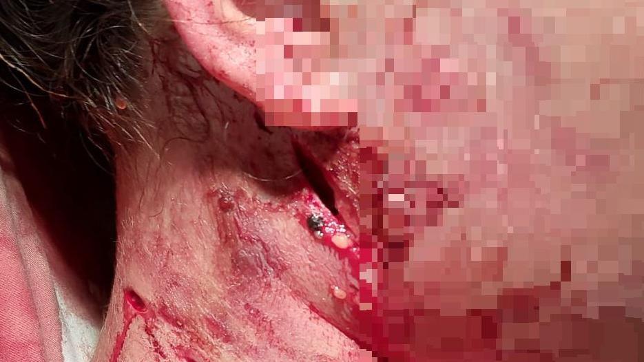 A small laceration in a girl's neck caused by an XL bully