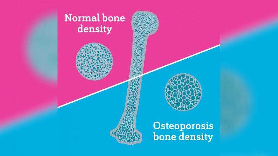 Diagram of a human bone and bone cells