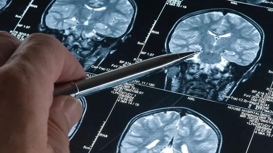 A hand holding a pen points at a sheet of brain scan results.