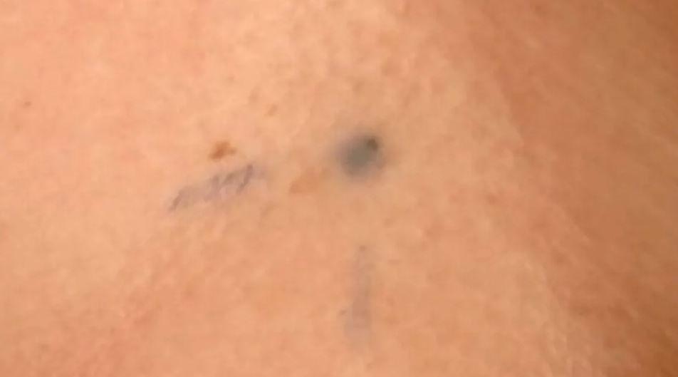 A section of skin showing three small dark blue tattoo marks to allow accurate delivery of radiotherapy.