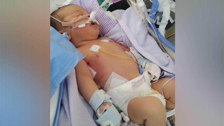 A newborn baby Piper in a hospital bed. She has a nappy on and many tubes going into her mouth and nose.