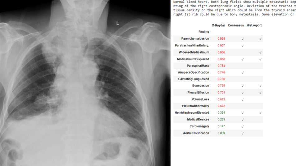 An example of the software scanning a chest X-ray