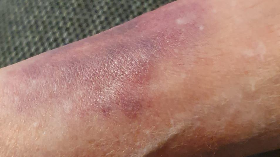 A zoomed in photo of Ms Clarke's arm. You can see there is pinkish-red bruising.