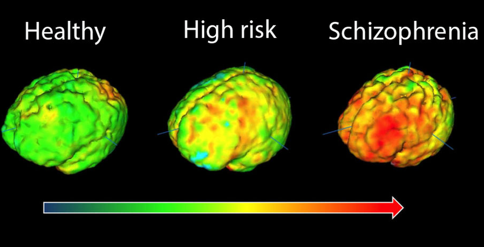 Brain scans