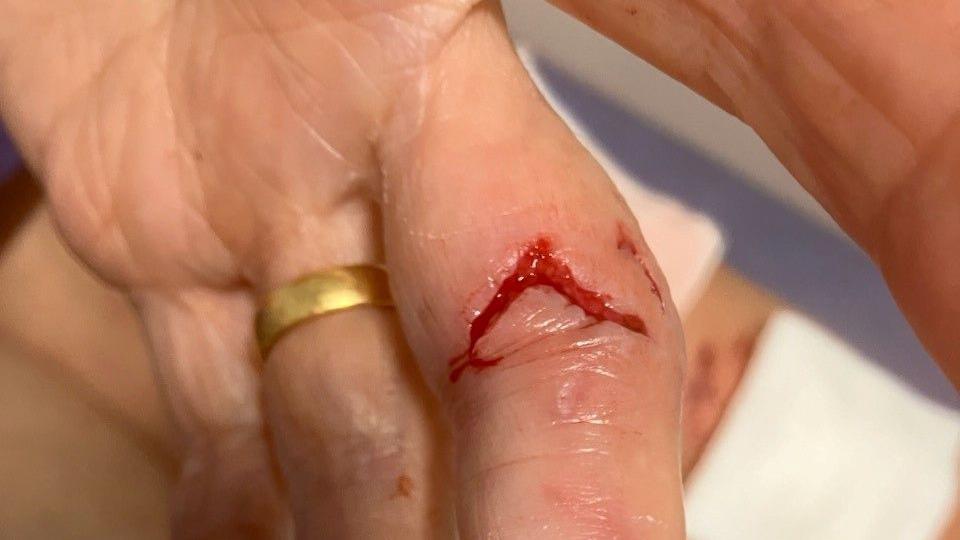 Pat's hand, showing a bite wound on her finger with blood