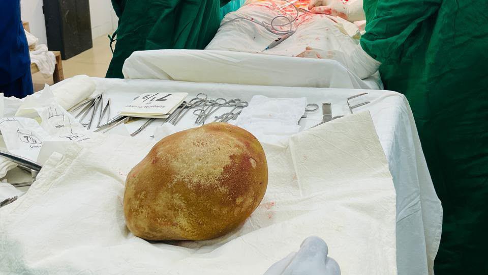 Close-up shot of the giant yellow bladder stone