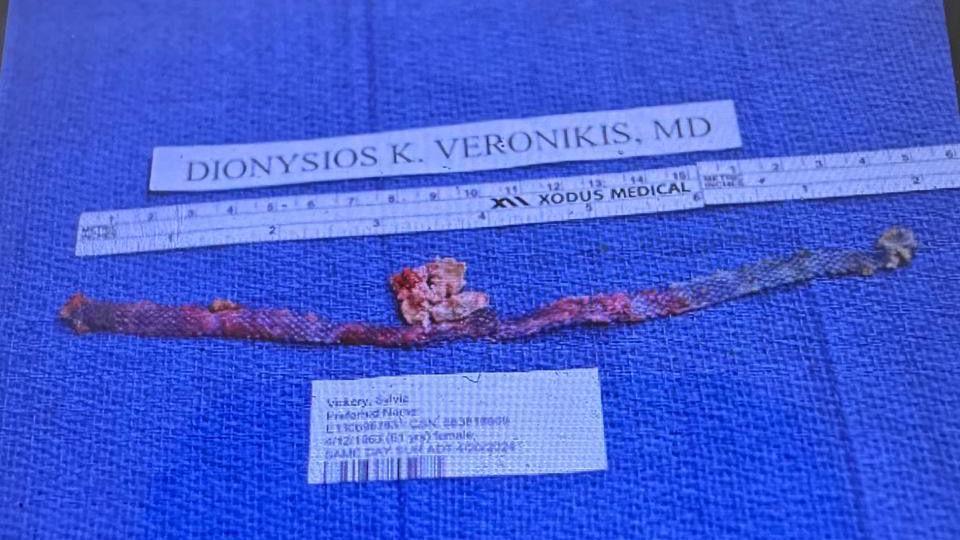 An image of the wire mesh removed in surgery measuring approximately 20 centimetres