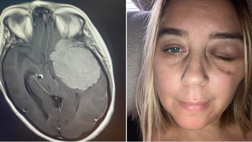 A split image of a scan of a brain showing a large tumour and of Harriet Annabelle with two bruised eyes