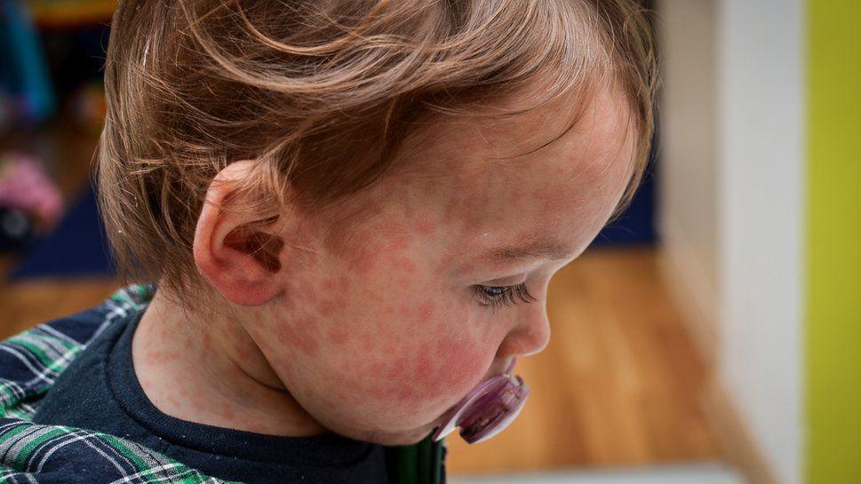 Baby with measles