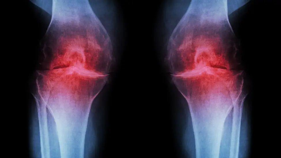 An x-ray of a pair of knees. There are red areas in the knee joints that stand out from the white bones.